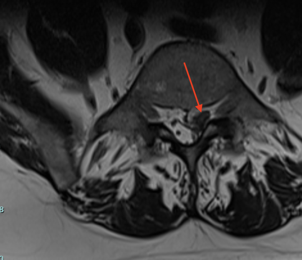 Magnetic Resonance Imaging showing the disc herniation on the left