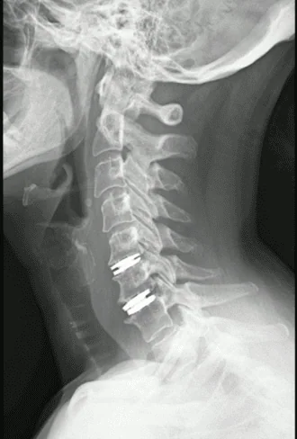 Hérnia discal cervical C5-C6 e C6-C7 tratada por Prótese de disco cervical: dor de 8 para 0 e movimento preservado.
