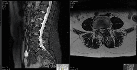 Canal lombar estreito L4-L5 tratada por endoscopia biportal (UBE): regresso à marcha aos 64 anos