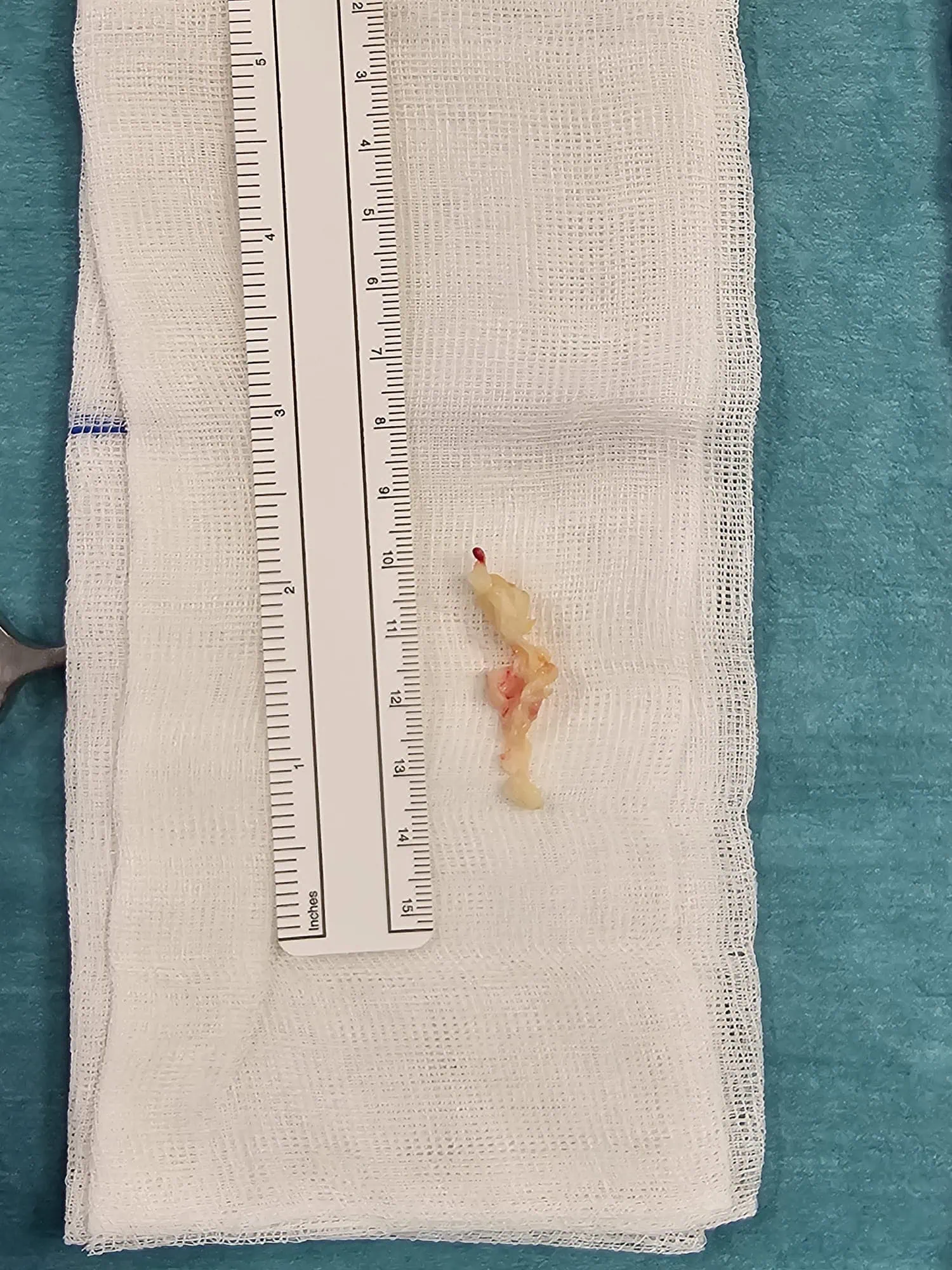 Fragmento discal removido durante a endoscopia biportal.