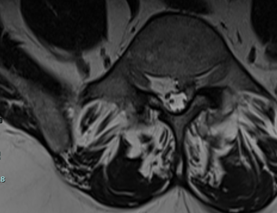 Hérnia discal lombar L4-L5 tratada por endoscopia biportal (UBE): resolução de uma ciatalgia intensa