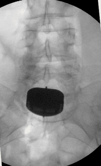 Doença degenerativa do disco L5-S1 com dor radicular tratada por prótese de disco (artroplastia lombar): resolução completa em um mês