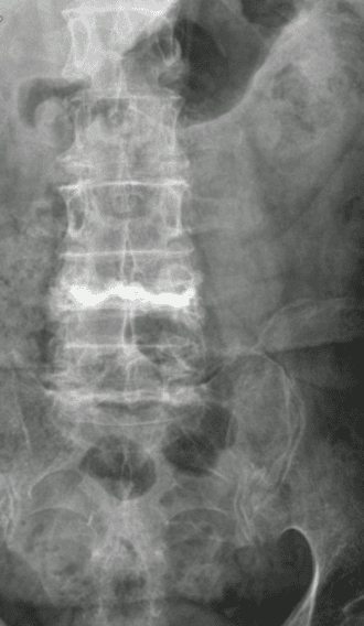 RX pós-operatório (frente): cimento a estabilizar o corpo vertebral de L4.