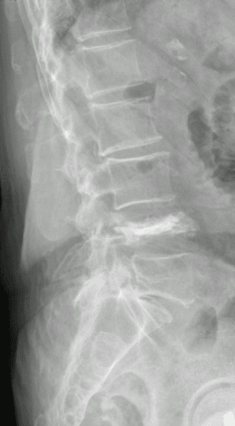 Fratura vertebral osteoporótica de L4 tratada por vertebroplastia: alívio da dor aos 96 anos