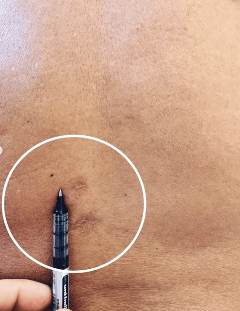 Hérnia discal lombar L2-L3 tratada por endoscopia biportal (UBE): quando o “peso” na perna ao caminhar vinha da coluna