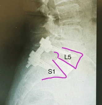Espondilolistese de L5-S1 por lise ístmica tratada por ALIF (artrodese lombar por via anterior): alívio da dor lombar e nas pernas
