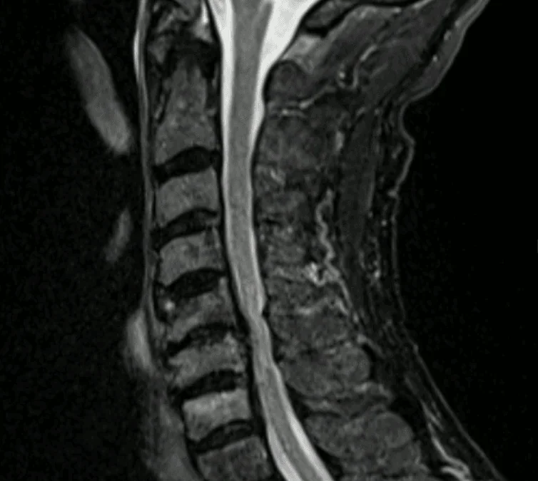 Mielopatia cervical degenerativa em C5-C6 tratada por ACDF (artrodese cervical anterior): descomprimir a medula para preservar a função