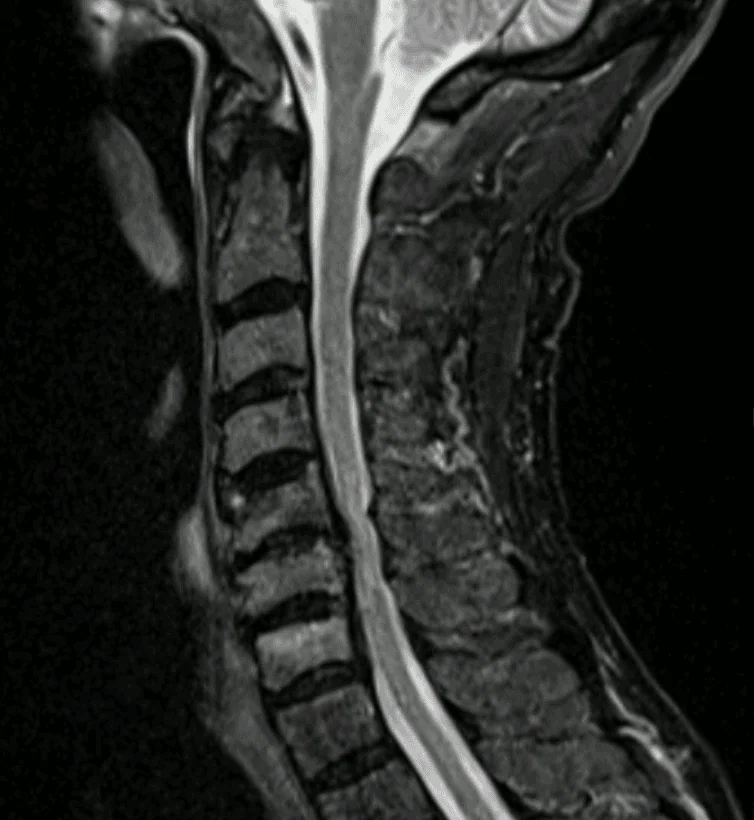 Ressonância magnética cervical a evidenciar estenose do canal e compressão medular anterior em C5-C6.