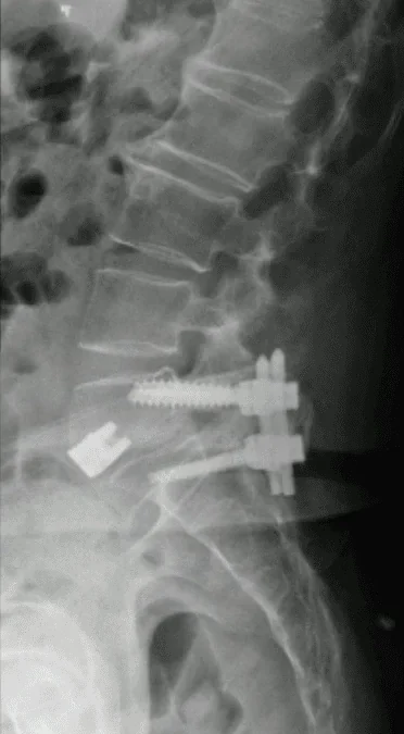 Dor lombar após cirurgia à coluna: revisão de uma pseudartrose de L5-S1 por ALIF (artrodese anterior)