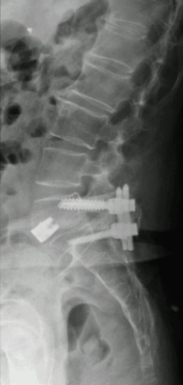 Radiografia lombar de perfil pós-revisão, com a coluna anterior reconstruída por cage de ALIF em L5-S1.