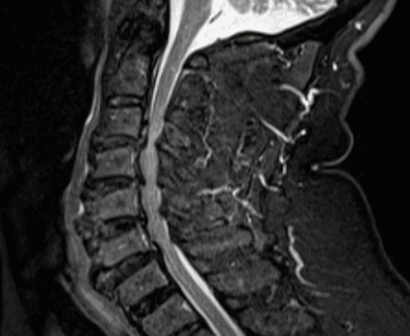 Mielopatia cervical em C3-C4 tratada por descompressão endoscópica posterior: recuperação neurológica completa, sem fusão multinível