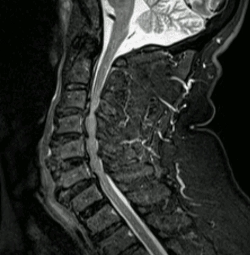 Ressonância magnética cervical a evidenciar mielomalácia em C3-C4 sobre estenose degenerativa multinível.